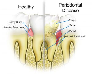 perioand_periodisease