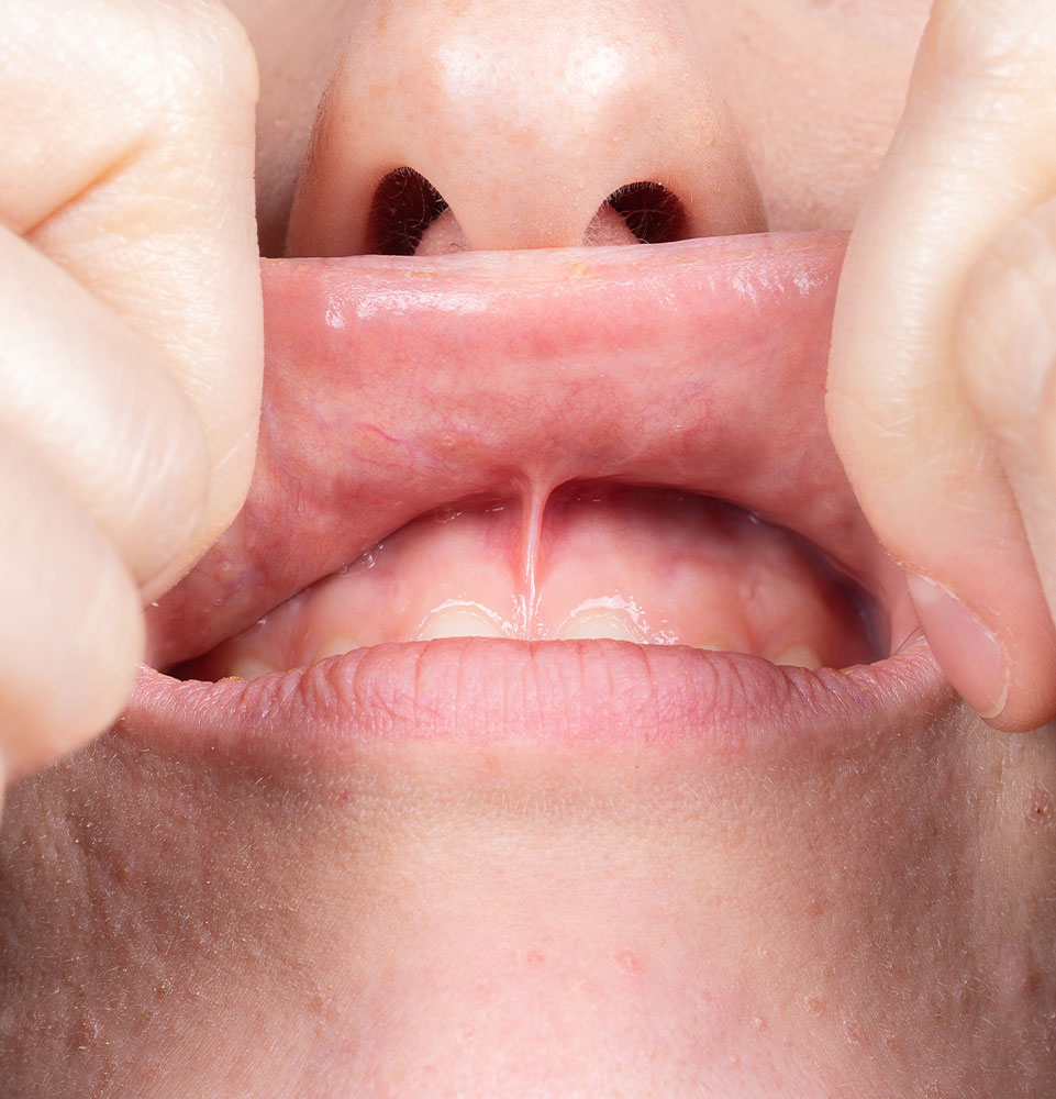 frenectomy close up