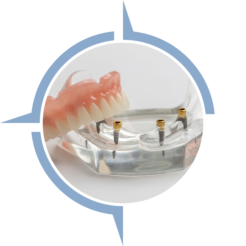 implant-supported denture prosthesis