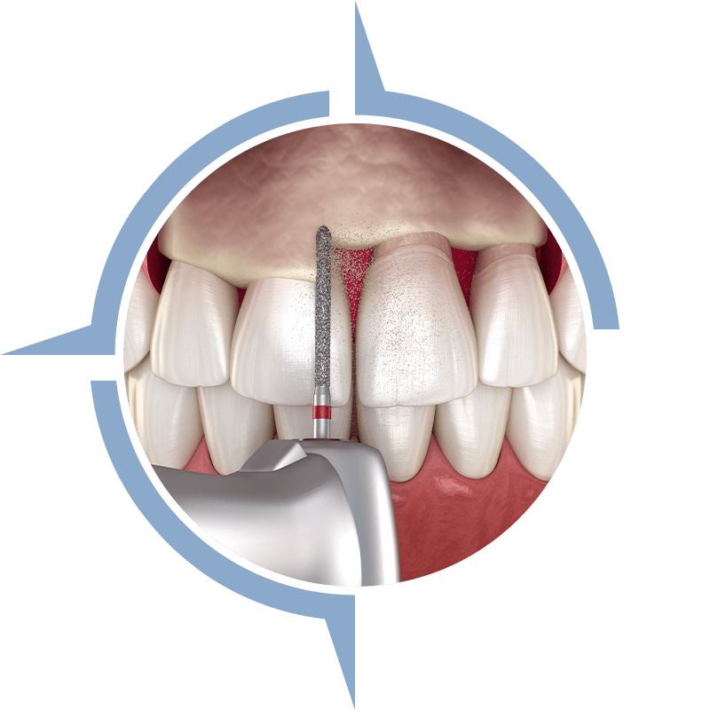 crown lengthening procedure