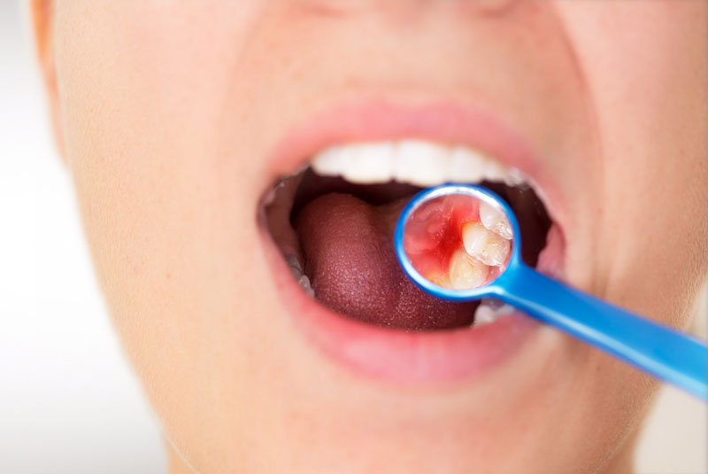 dental patient needing perio treatment