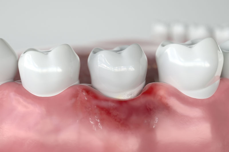 gum disease 3d