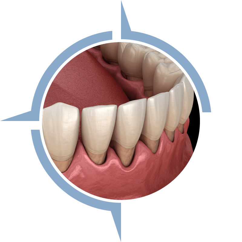 gum recession
