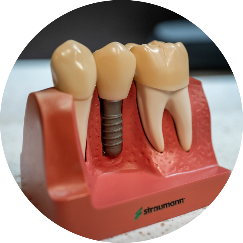 implant model