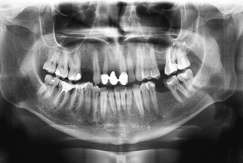 missing teeth xray