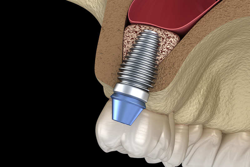 Osteotome Sinus Lift