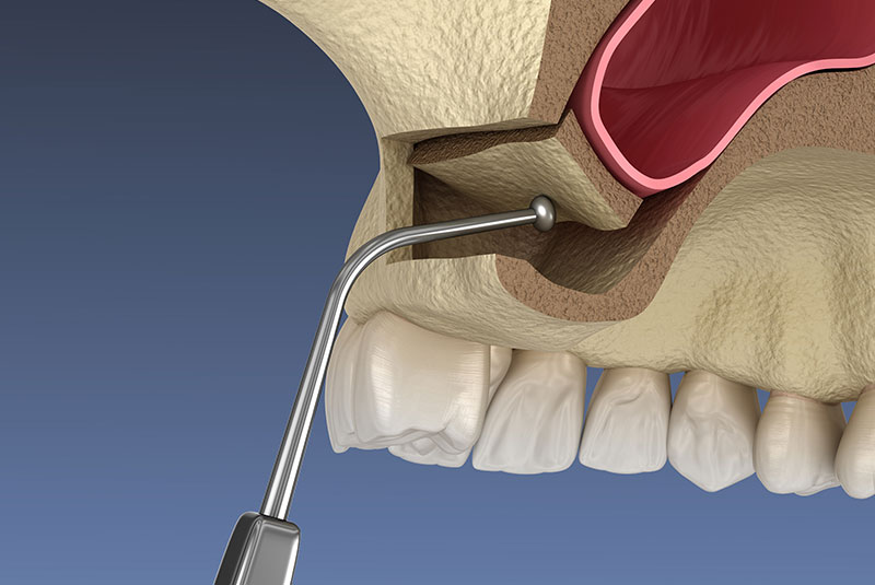 Lateral Window Sinus Lift